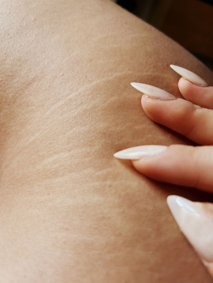 How Castor Oil Breaks Down Scar Tissue