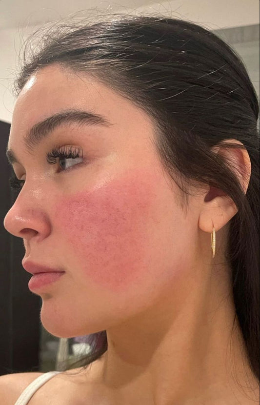 Castor Oil For Rosacea