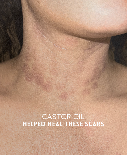 Castor-Oil-for-Laser-Burns iAMA
