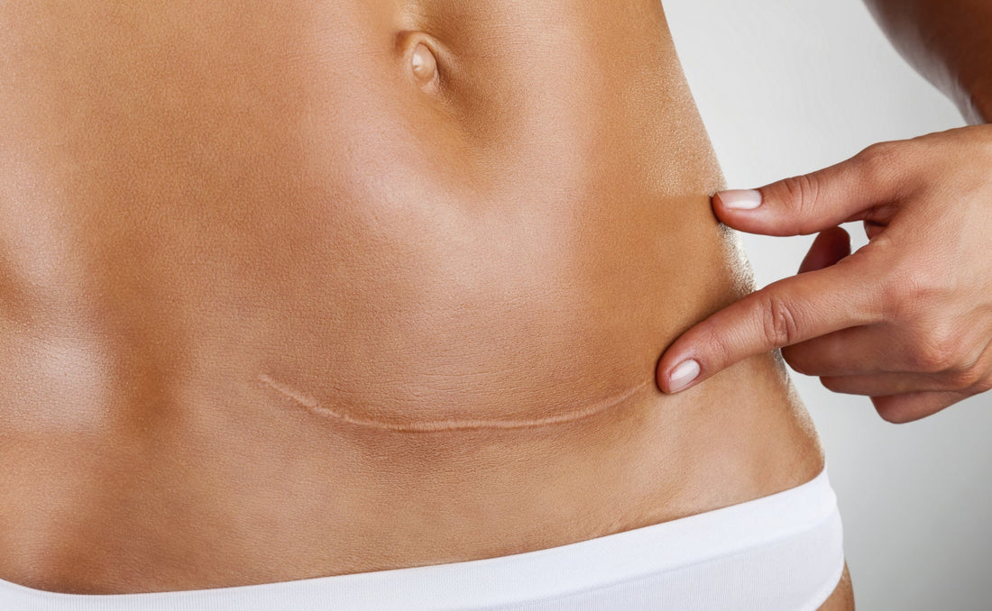 How-Castor-Oil-Breaks-Down-Scar-Tissue iAMA