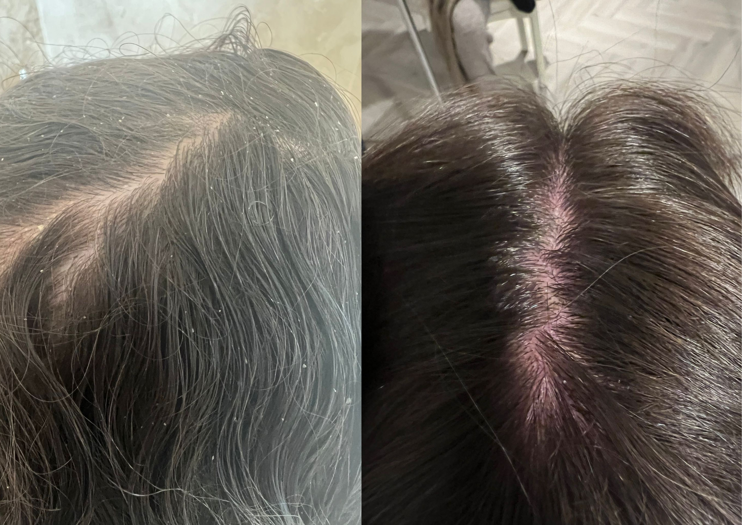 dandruff on scalp before and after using castor oil